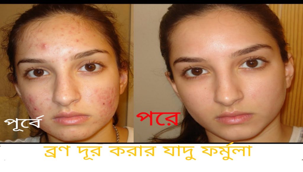 A magical way to remove pimples