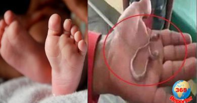 a baby from uttar pradesh mistakenly swallows a baby snake