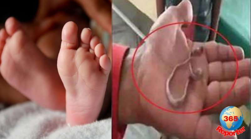 a baby from uttar pradesh mistakenly swallows a baby snake