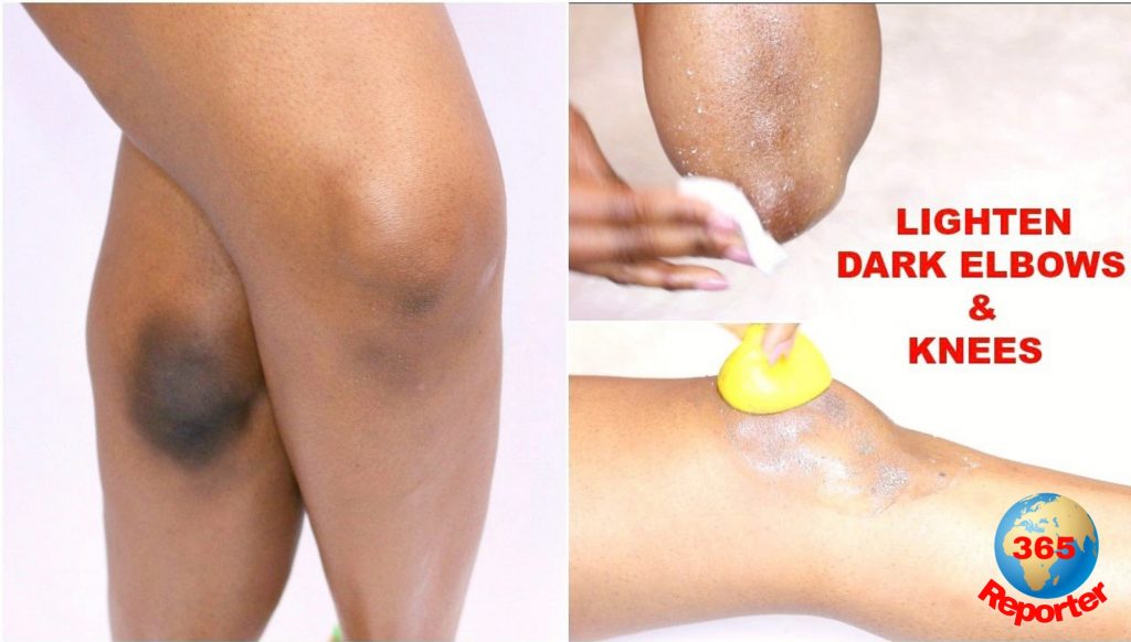 how to remove black spots on your knees and elbows