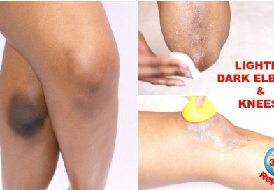 how to remove black spots on your knees and elbows